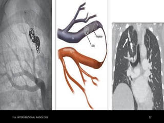 PUL.INTERVENTIONAL RADIOLOGY 52
 
