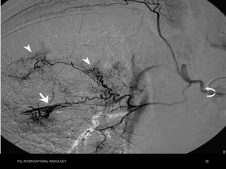 PUL.INTERVENTIONAL RADIOLOGY 55
 
