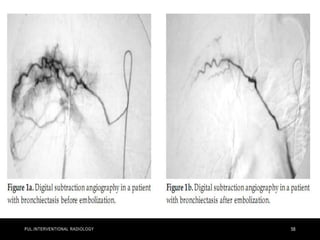 PUL.INTERVENTIONAL RADIOLOGY 58
 