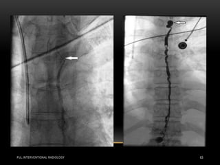 PUL.INTERVENTIONAL RADIOLOGY 63
 