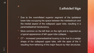Luftcycle Sign Comprehensive Overview of Pulmonary Lobar Collapse: Causes ...