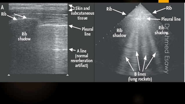 lung ultrasound all thing you want to know Dr Ahmed Esawy | PPT