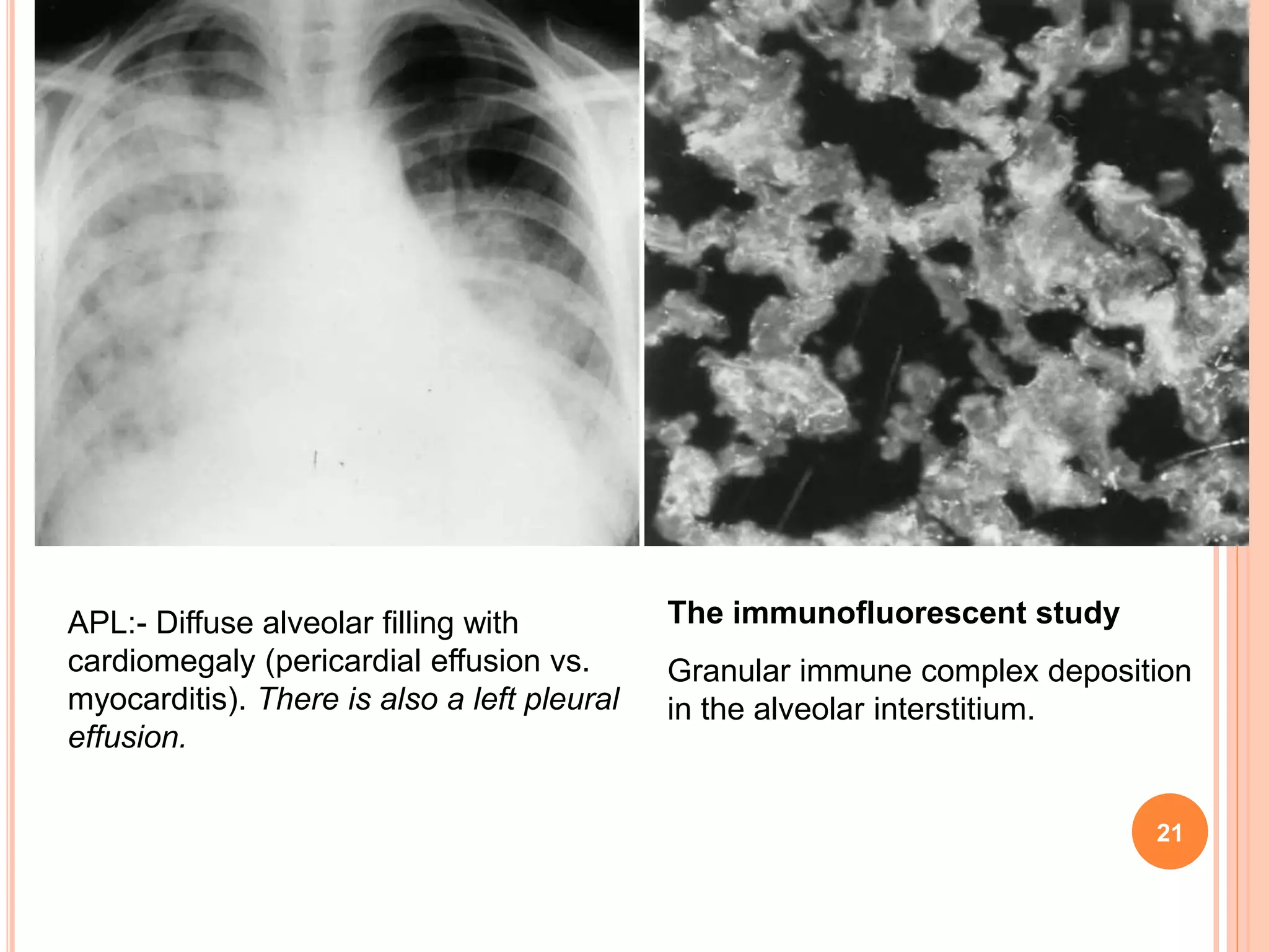 Pulmonary manifestations of collagen vascular diseases | PPTX