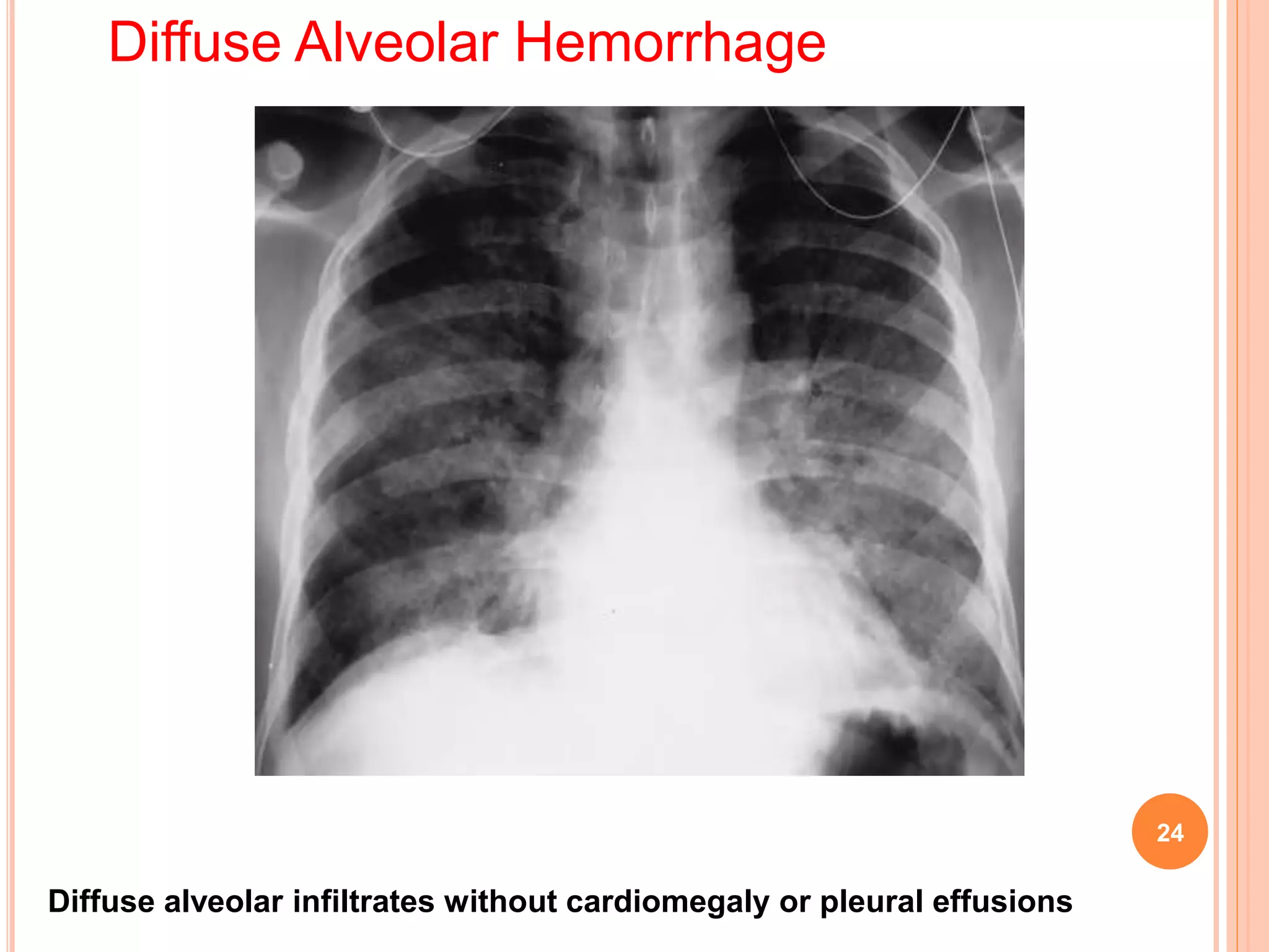 Pulmonary manifestations of collagen vascular diseases | PPTX