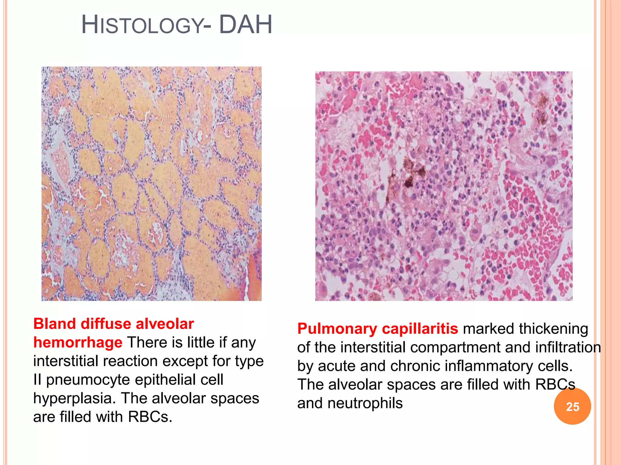 Pulmonary manifestations of collagen vascular diseases | PPTX