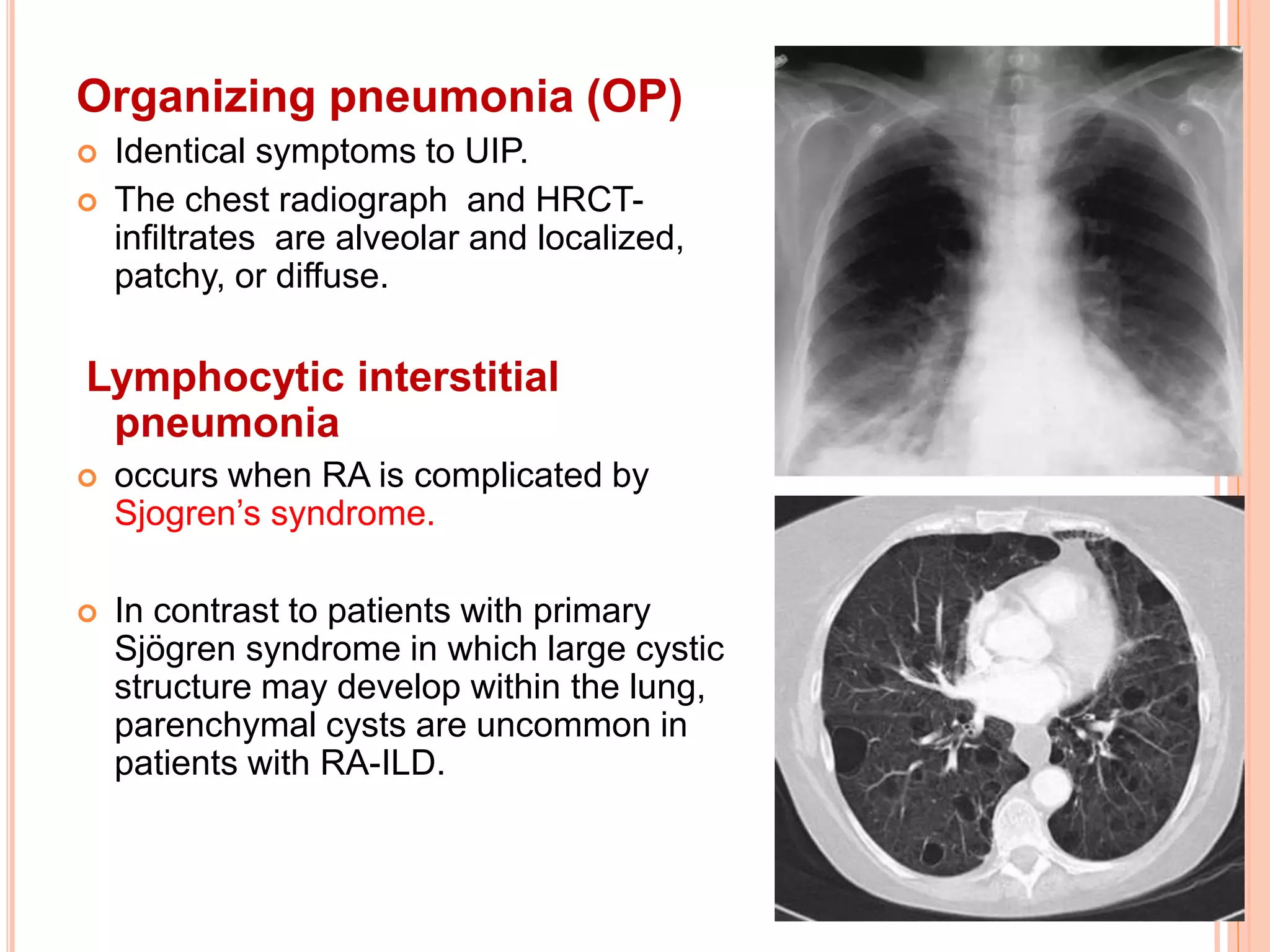 Pulmonary manifestations of collagen vascular diseases | PPTX