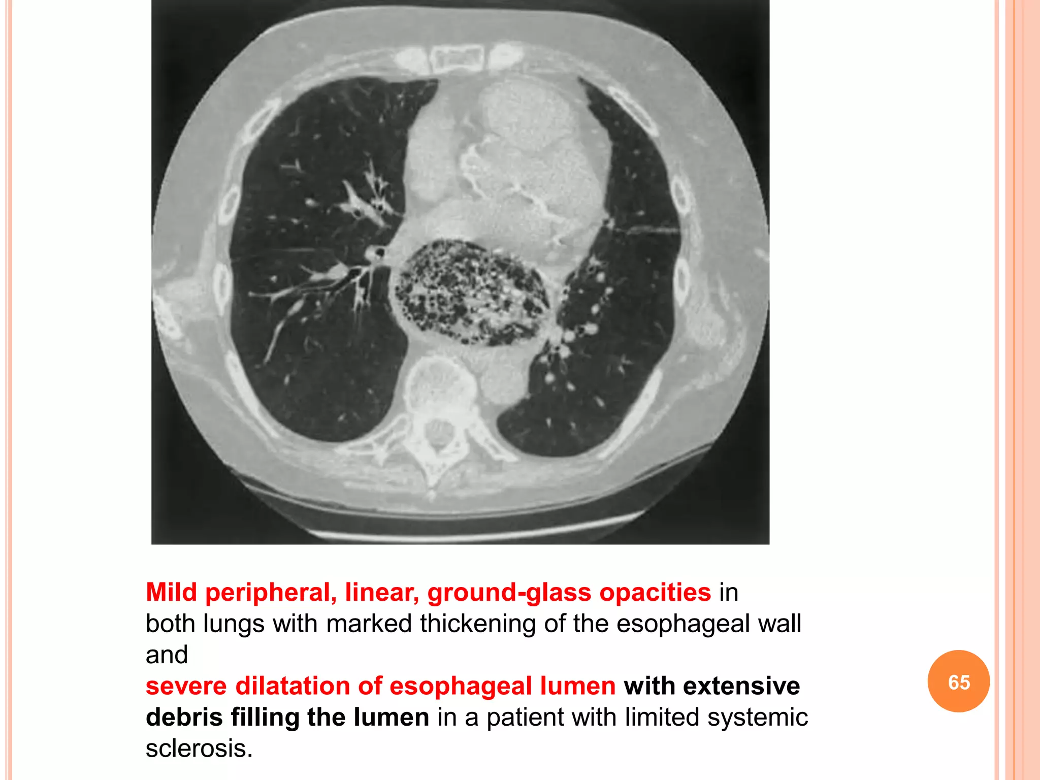 Pulmonary manifestations of collagen vascular diseases | PPTX