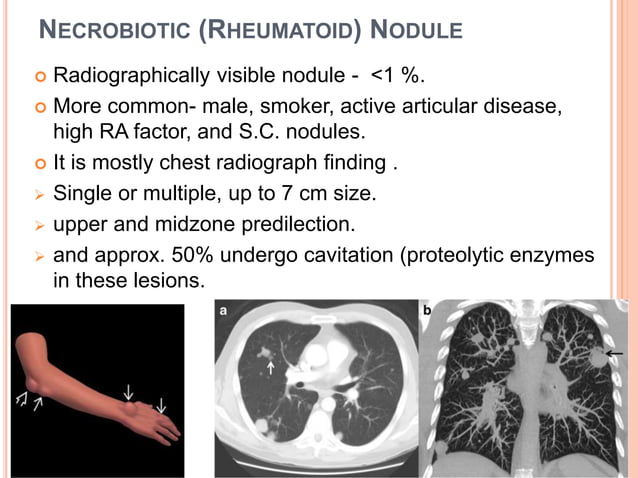 Pulmonary manifestations of collagen vascular diseases | PPTX