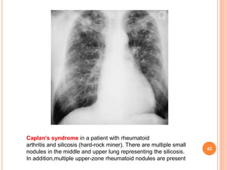 Pulmonary manifestations of collagen vascular diseases | PPTX
