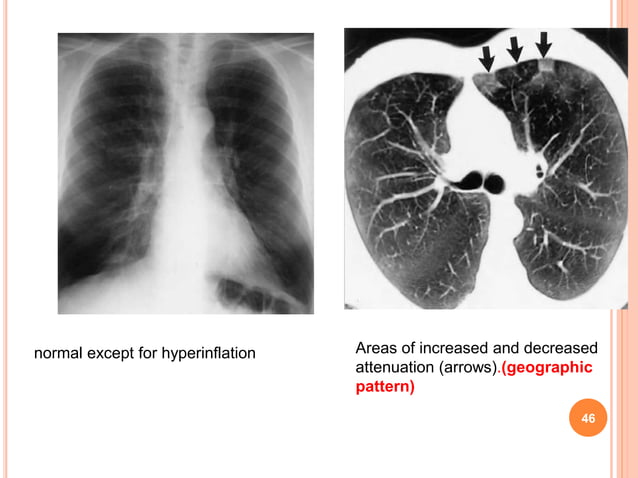 Pulmonary manifestations of collagen vascular diseases | PPTX