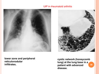 Pulmonary manifestations of collagen vascular diseases | PPTX