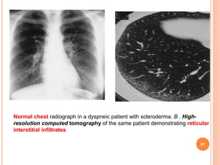 Pulmonary manifestations of collagen vascular diseases | PPTX