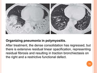 Pulmonary manifestations of collagen vascular diseases | PPTX