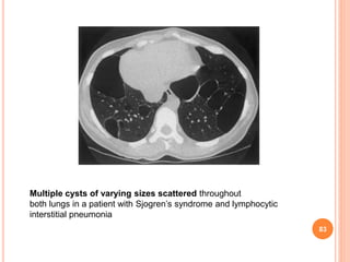 Pulmonary manifestations of collagen vascular diseases | PPTX