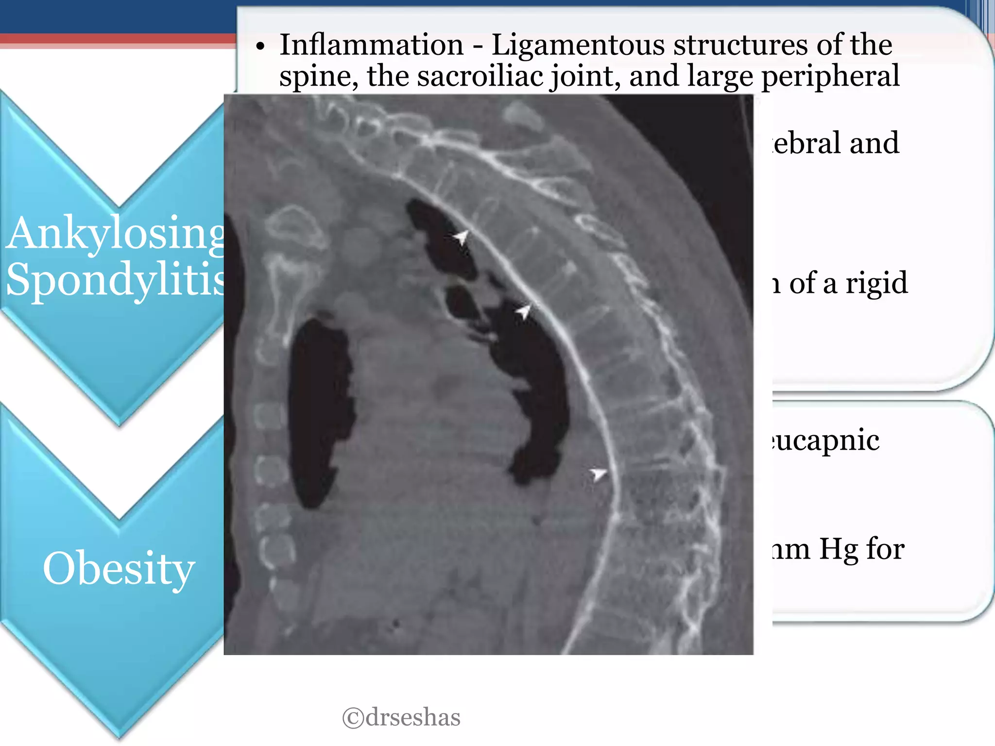Spondylitis Ribs Pulmonary manifestations of systemic diseases (non CTD) | PPTX