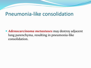 Pneumonia-like consolidation
 Adenocarcinoma metastases may destroy adjacent
lung parenchyma, resulting in pneumonia-like
consolidation.
 