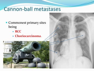 Cannon-ball metastases
 Commonest primary sites
being
 RCC
 Choriocarcinoma.
 