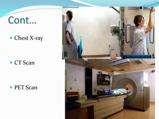 Cont…
 Chest X-ray
 CT Scan
 PET Scan
 