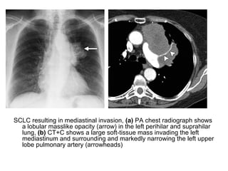 Diagnostic Imaging of Pulmonary Tumors | PPT
