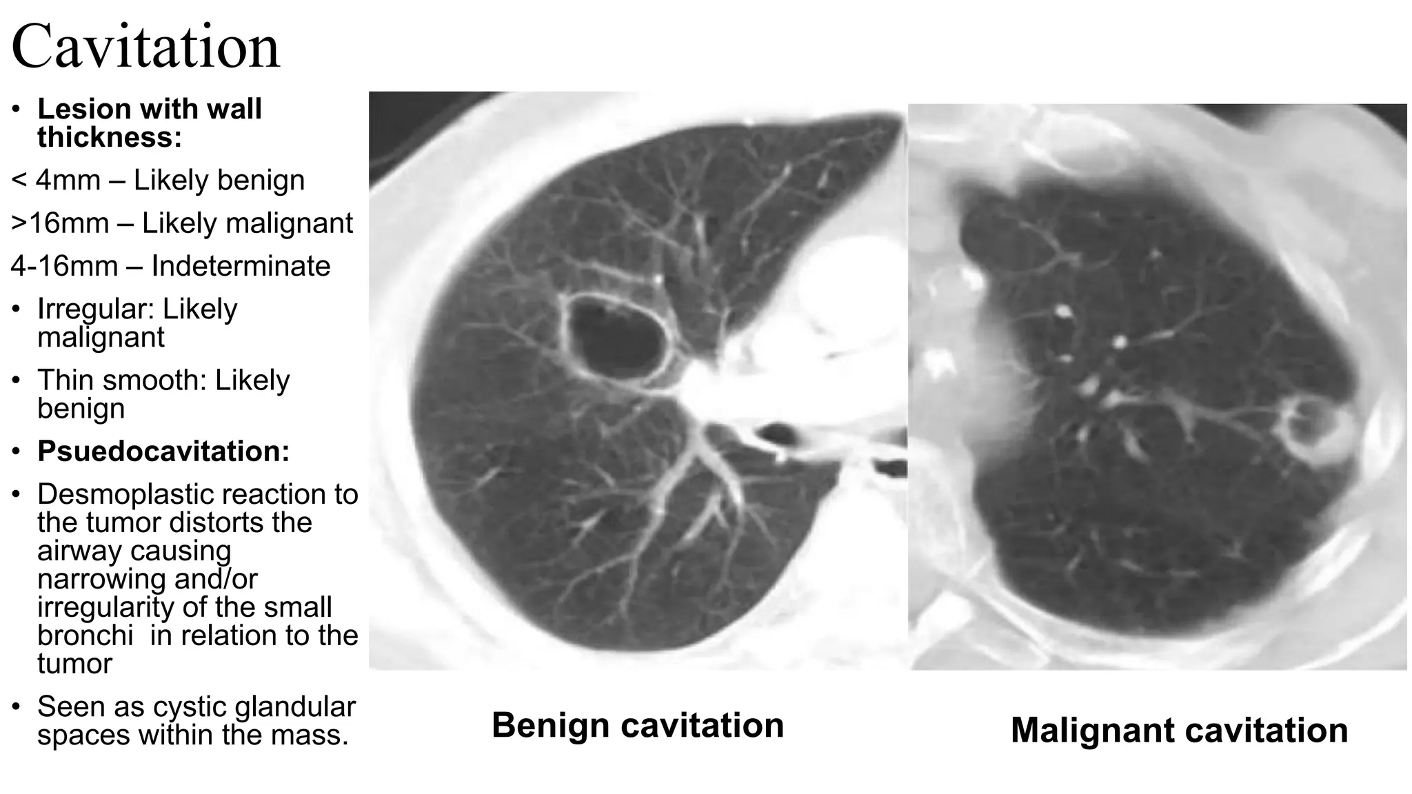 Approach to imaging of Solitary pulmonary nodule .pptx
