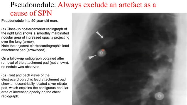 Approach to imaging of Solitary pulmonary nodule .pptx