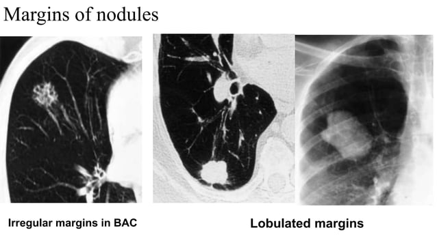 Approach to imaging of Solitary pulmonary nodule .pptx