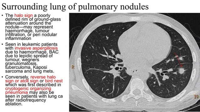 Approach to imaging of Solitary pulmonary nodule .pptx