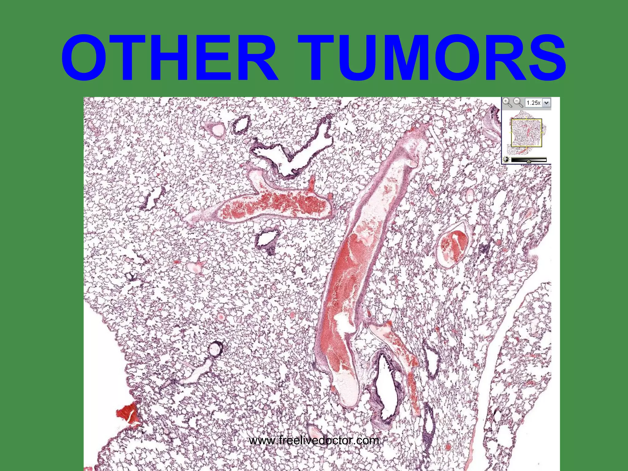 OTHER TUMORS www.freelivedoctor.com 