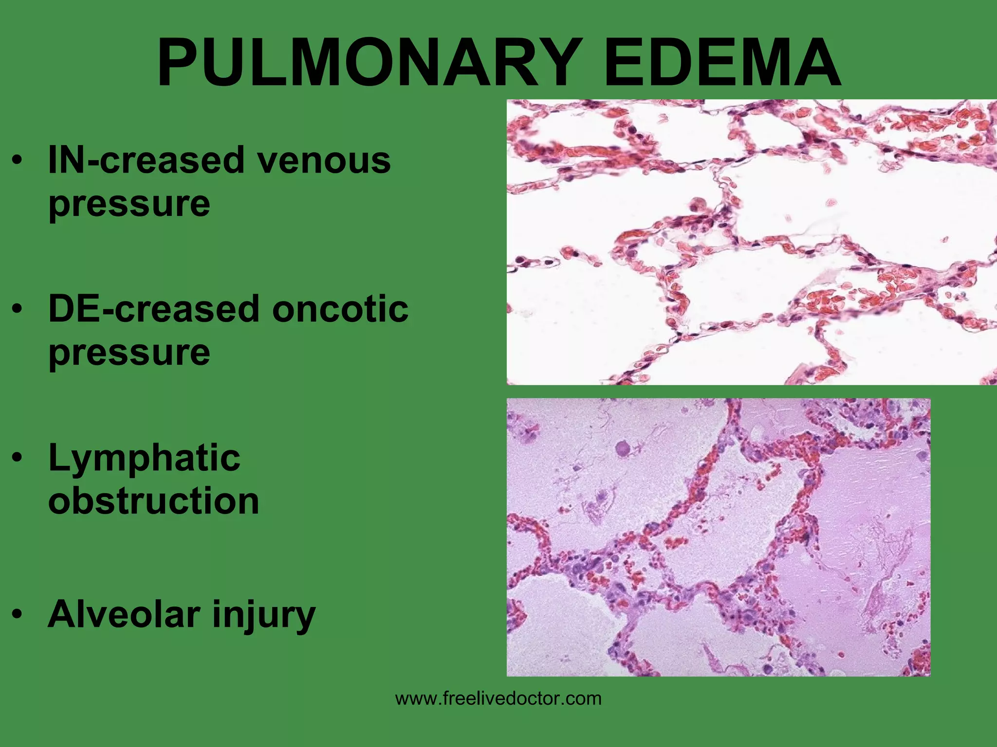 PULMONARY EDEMA IN-creased venous pressure DE-creased oncotic pressure Lymphatic obstruction Alveolar injury www.freelivedoctor.com 
