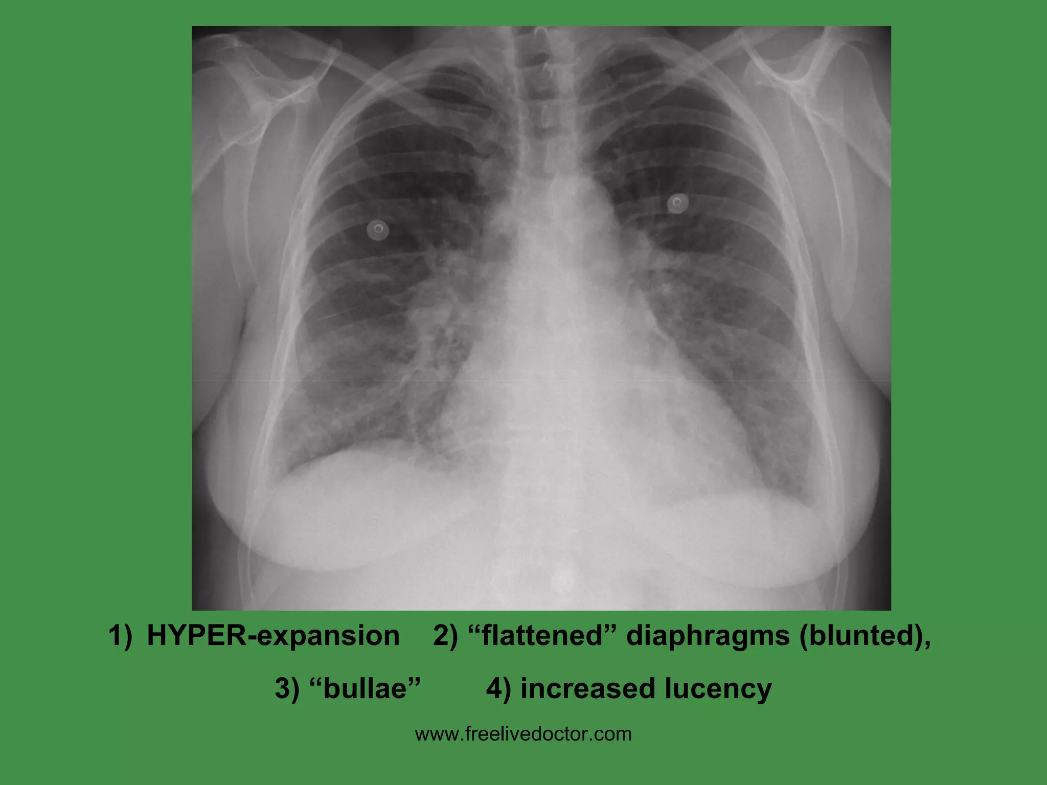 HYPER-expansion  2) “flattened” diaphragms (blunted),  3) “bullae”  4) increased lucency www.freelivedoctor.com 