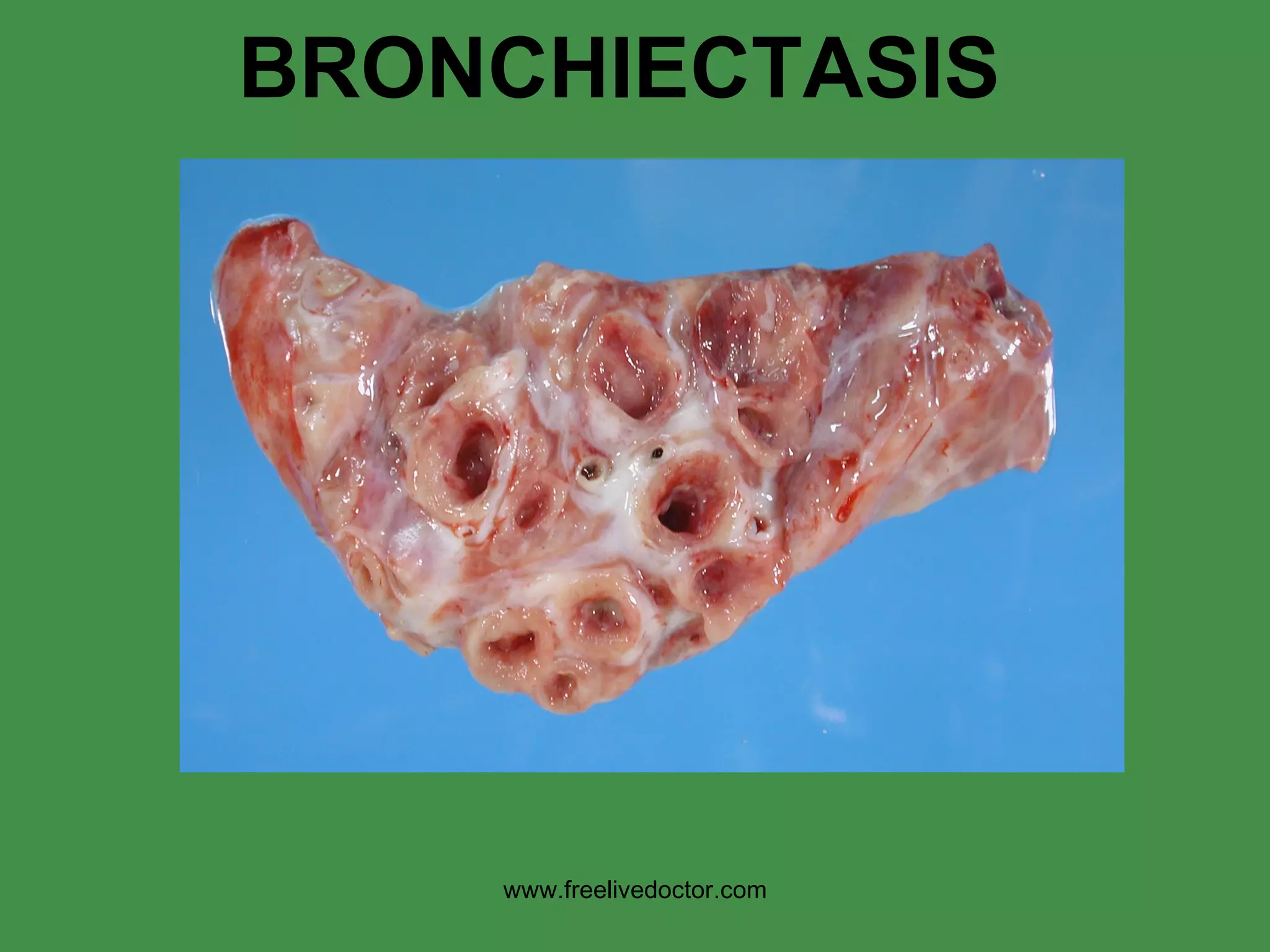 BRONCHIECTASIS www.freelivedoctor.com 