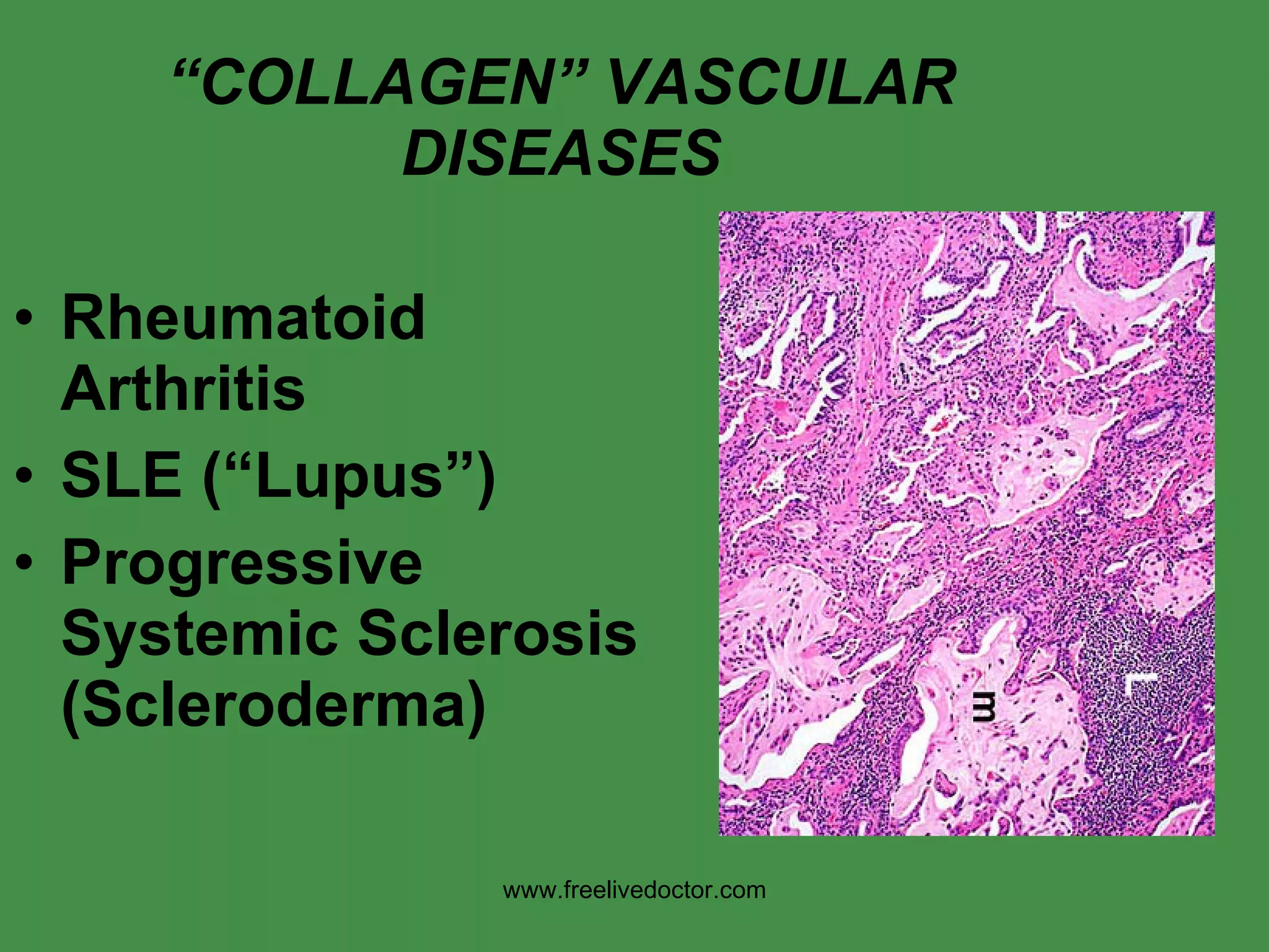 “ COLLAGEN” VASCULAR DISEASES Rheumatoid Arthritis SLE (“Lupus”) Progressive Systemic Sclerosis (Scleroderma) www.freelivedoctor.com 