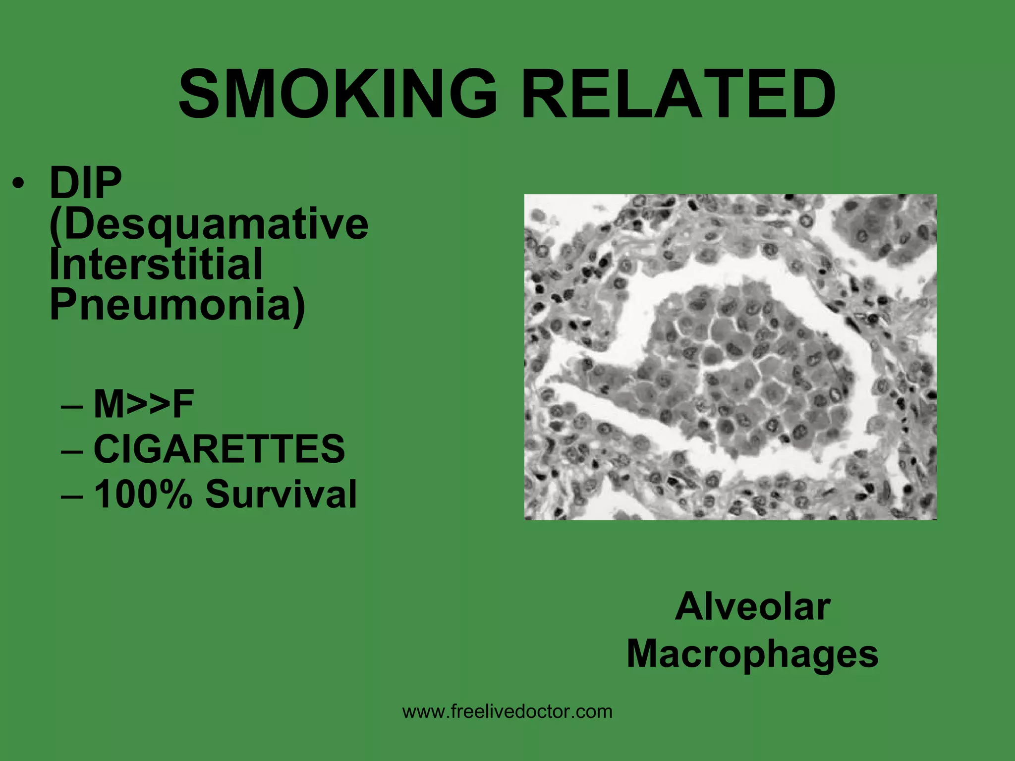SMOKING RELATED DIP (Desquamative Interstitial Pneumonia) M>>F CIGARETTES 100% Survival Alveolar Macrophages www.freelivedoctor.com 