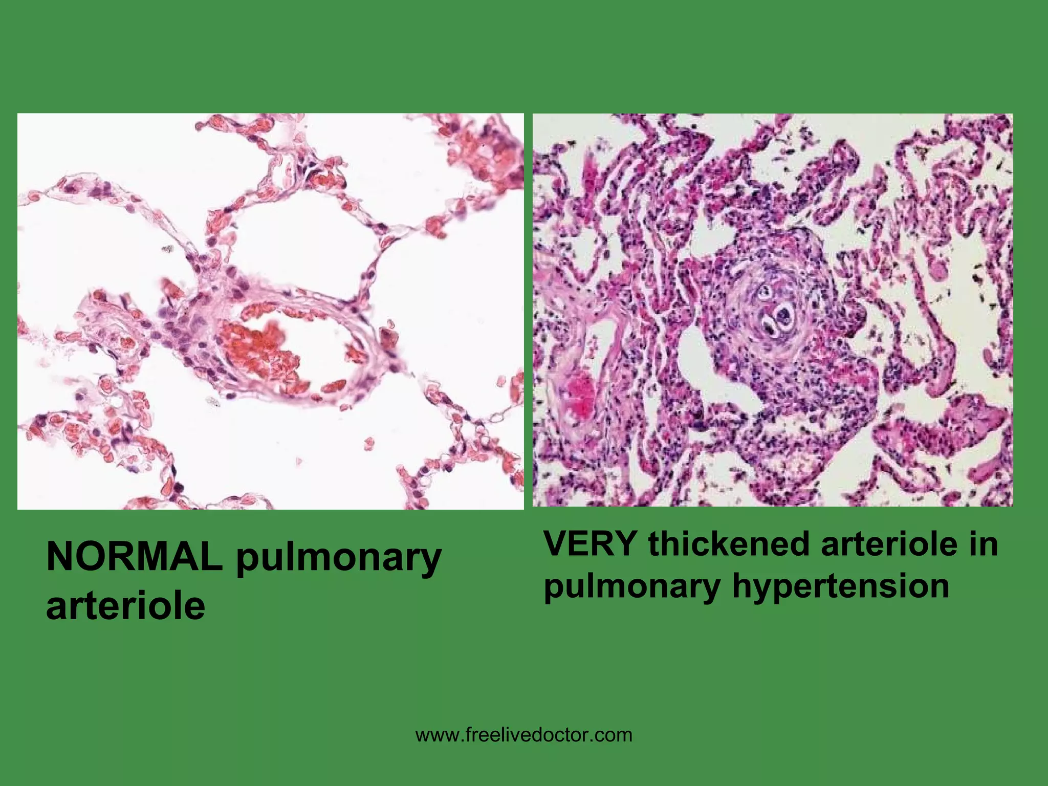 VERY thickened arteriole in pulmonary hypertension NORMAL pulmonary arteriole www.freelivedoctor.com 