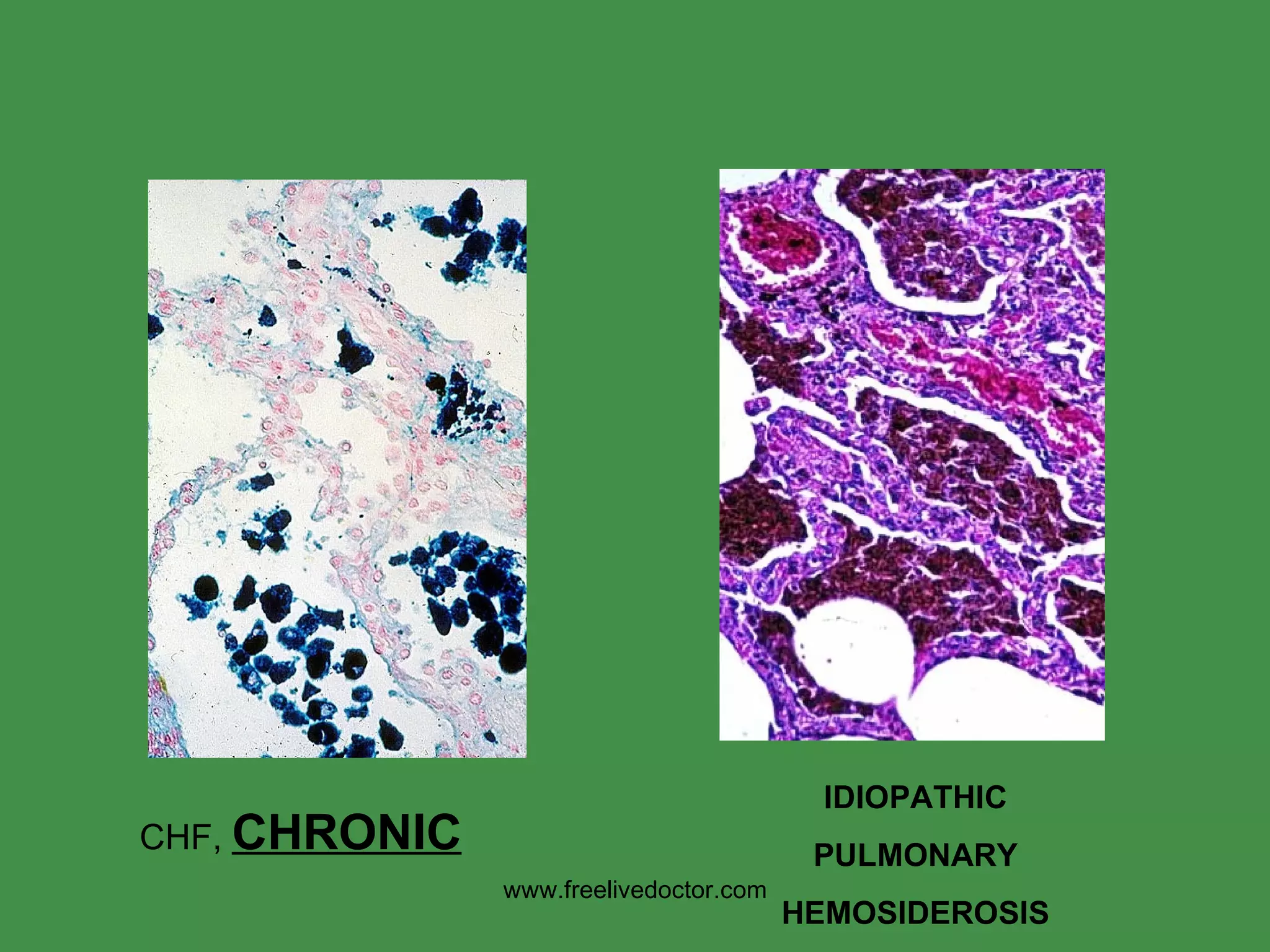 CHF,  CHRONIC IDIOPATHIC PULMONARY HEMOSIDEROSIS www.freelivedoctor.com 