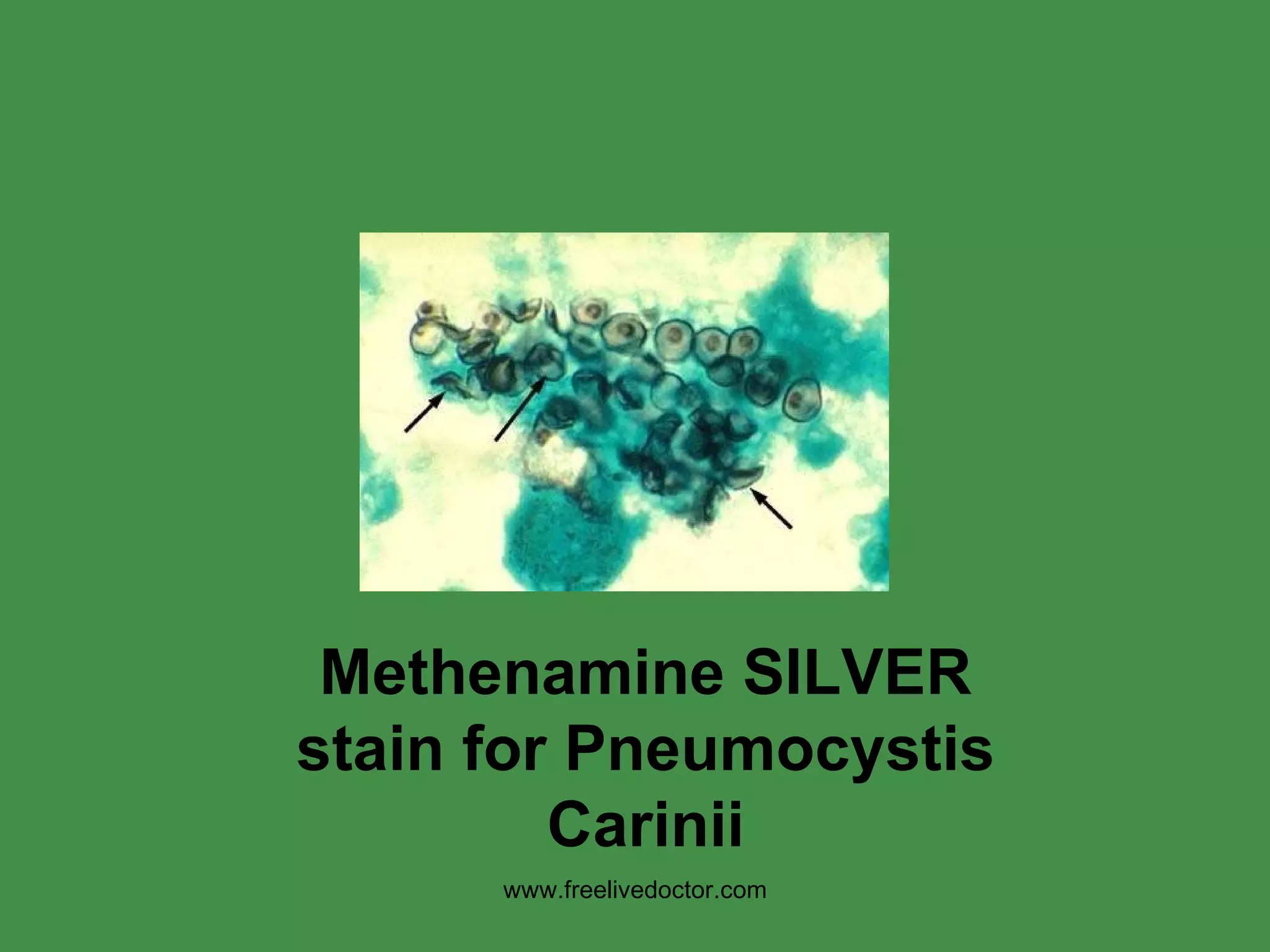 Methenamine SILVER stain for Pneumocystis Carinii www.freelivedoctor.com 