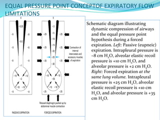 EQUAL PRESSURE POINT CONCEPTOF EXPIRATORY FLOW
LIMITATIONS
Schematic diagram illustrating
dynamic compression of airways
and the equal pressure point
hypothesis during a forced
expiration. Left: Passive (eupneic)
expiration. Intrapleural pressure is
–8 cm H2O, alveolar elastic recoil
pressure is +10 cm H2O, and
alveolar pressure is +2 cm H2O.
Right: Forced expiration at the
same lung volume. Intrapleural
pressure is +25 cm H2O, alveolar
elastic recoil pressure is +10 cm
H2O, and alveolar pressure is +35
cm H2O.
 