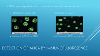 P Anca Pattern Pulmonary renal syndrome by Dr Bharat Rewaria | PPTX