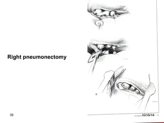 Right pneumonectomy 
39 10/15/14 
 