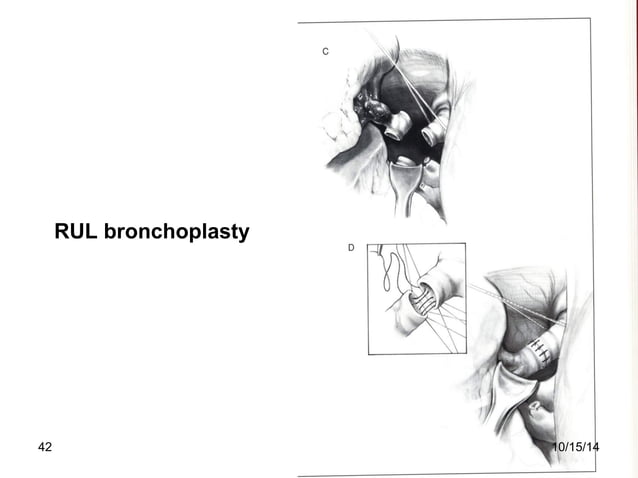 Lung Resection Instruments Pulmonary Resection Definition – QJLZ