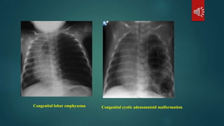 Congenital cystic adenomatoid malformationCongenital lobar emphysema
 