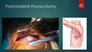 Postrolateral thoracotomy
 