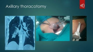Axillary thoracotomy
 