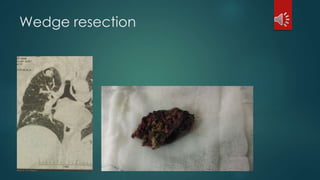 Wedge resection
 