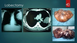 Lobectomy
 