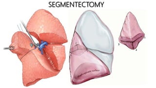 Open Segmentectomy Pulmonary resections | PPTX