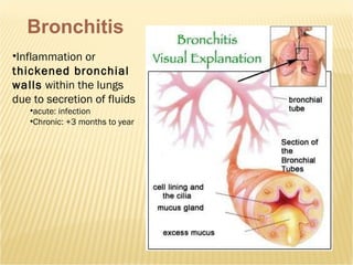 Bronchitis Inflammation or  thickened bronchial walls  within the lungs due to secretion of fluids acute: infection Chronic: +3 months to year 