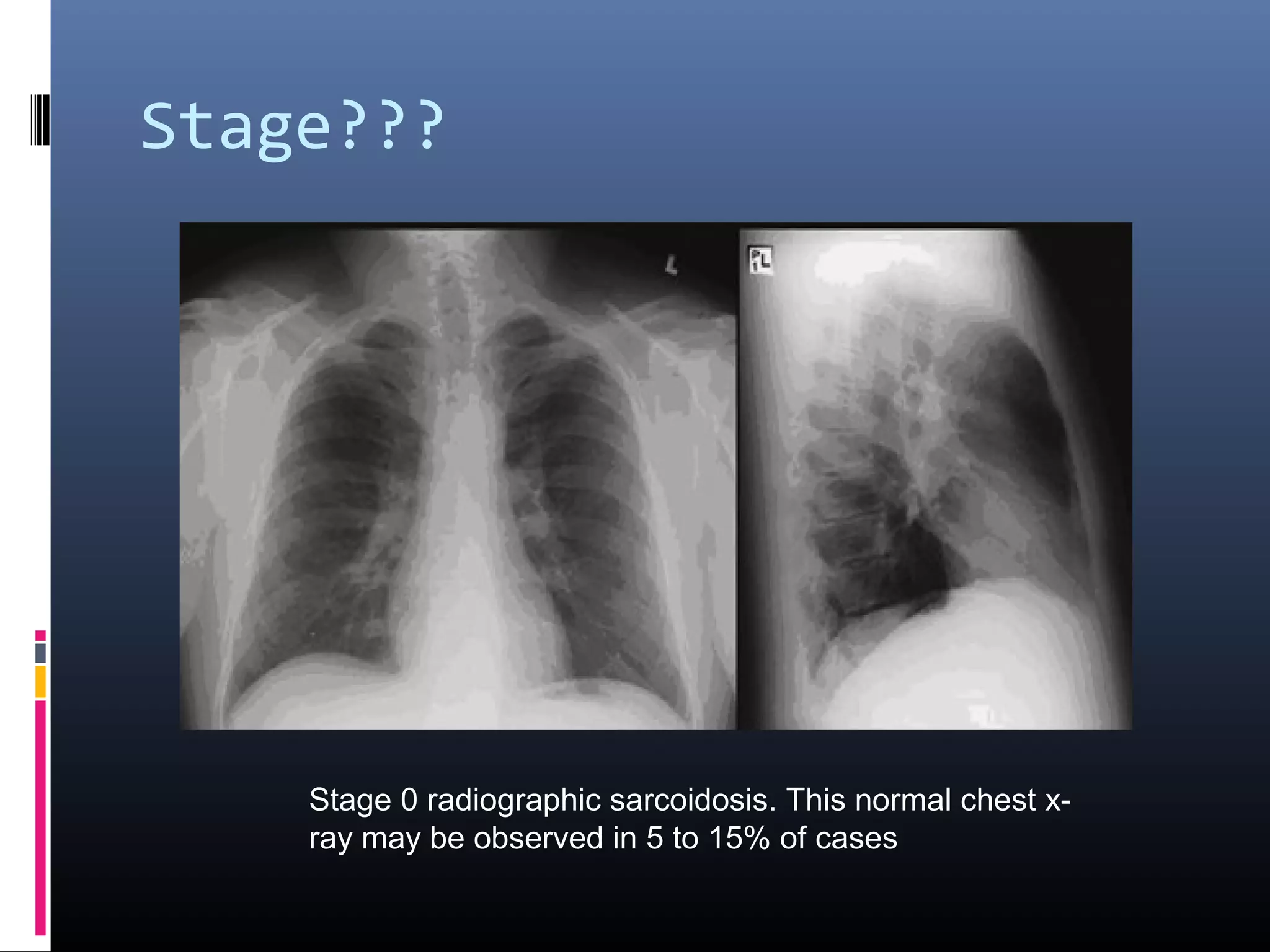 Scadding Radiological Classification Pulmonary sarcoidosis | PPT