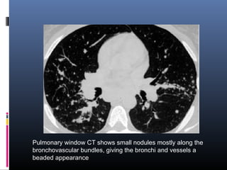 Pulmonary window CT shows small nodules mostly along the 
bronchovascular bundles, giving the bronchi and vessels a 
beaded appearance 
 
