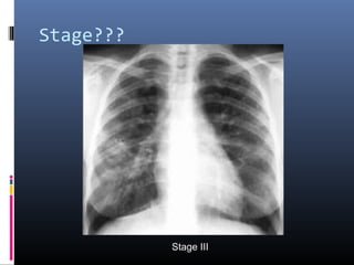 Stage??? 
Stage III 
 